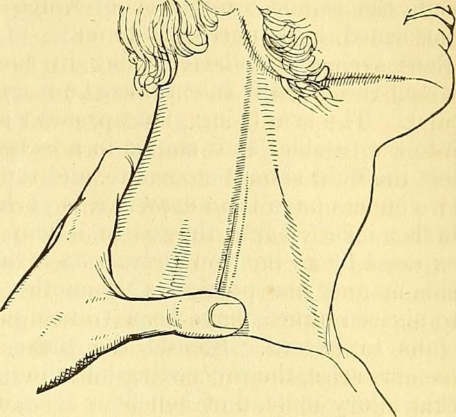 Image from page 462 of "A system of surgery : pathological, diagnostic, therapeutic, and operative" (1866)