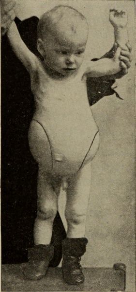 Image from page 246 of "Diseases of children" (1916)