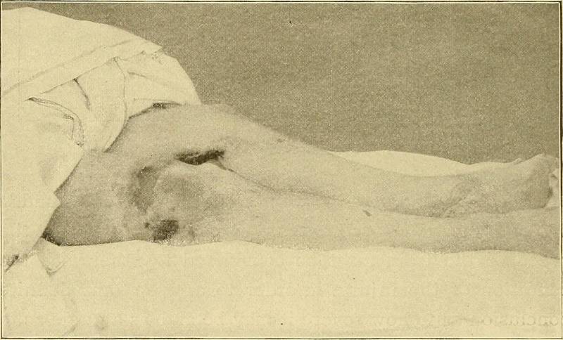Image from page 51 of "Railway surgery : a handbook on the management of injuries" (1899)
